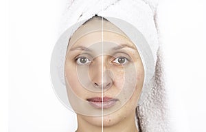 Face of young woman before and after skin healing. Concept of cosmetic effects, treatment and skin care