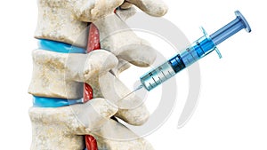 Facet joint injection, therapy against backbone injury or pain. Close-up of vertebrae with a syringe isolated on a white