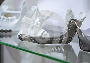 Facial bone lower human jaw individual prototype printed 3D printer metal powder