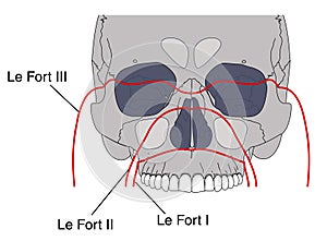 Facial fractures