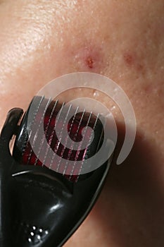 Facial massage with microneedle dermaroller for the treatment of scars, wrinkles and for facial rejuvenation. photo