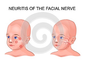 Facial nerve neuritis in a child
