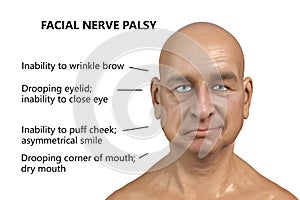 Facial nerve paralysis