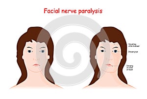 Facial nerve paralysis. Bell`s palsy