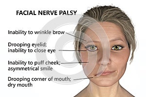 Facial nerve paralysis, Bell's palsy