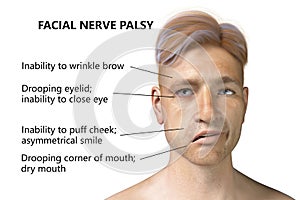 Facial nerve paralysis, Bell's palsy