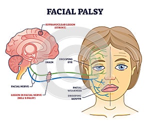 Facial palsy and muscles weakness because of nerve damage outline diagram photo