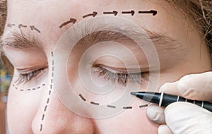 Facial plastic surgery. Hand is drawing lines with marker around eye