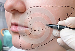 Facial plastic surgery. Hand is drawing lines with marker on cheek