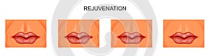 Facial rejuvenation, nasolabial folds