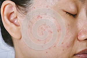Facial skin problem, Acne disease in adult, Close up woman face with whitehead pimples, Oily greasy face photo