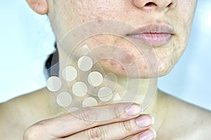 Facial skin problem with acne patch, Close up woman face with whitehead pimples and acne absorbing pad