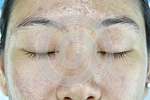 Facial skin problem, Aging problem in adult, wrinkle, acne scar