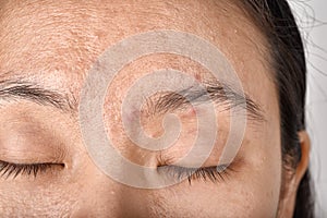 Facial skin problem, Aging problem in adult, wrinkle, acne scar, large pore and dark spot photo