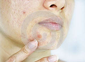 Facial skin problem, Close up woman face with whitehead pimples and acne patch photo