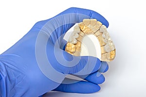 Fake teeth. ceramic teeth. dental bridges. orthopedic dentistry. cermet bridges are on the gypsum model after manufacturing. photo