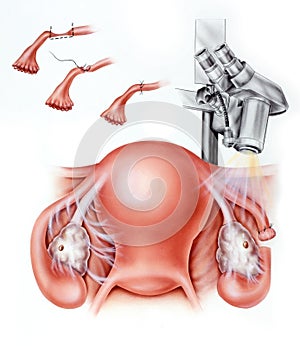 Fallopian Tube Infertility