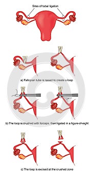 Fallopian tube ligation photo