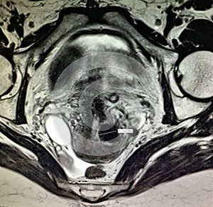 Fallopian tube neoplasm hematosalpinx pathology