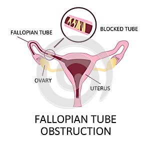 Fallopian tube obstruction or Blocked fallopian tubes