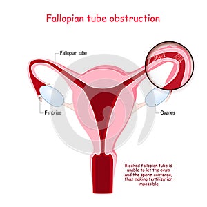 Fallopian tube obstruction. Cross section of Uterus. Close-up of Blocked fallopian tube photo