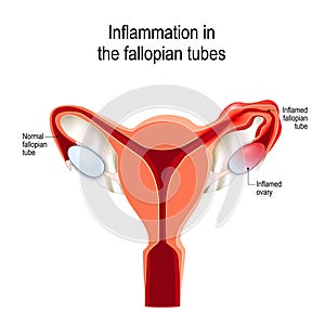 Fallopian tubes Inflammation