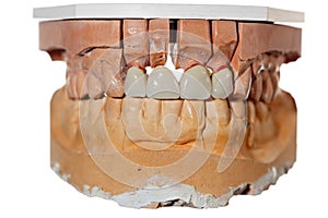 False teeth prosthesis