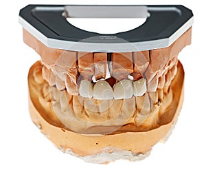 False teeth prosthesis