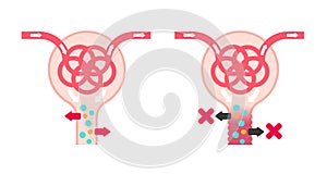 Fanconi syndrome causes illustration