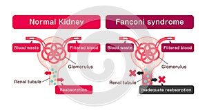 Fanconi syndrome causes illustration