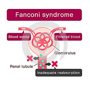 Fanconi syndrome causes illustration