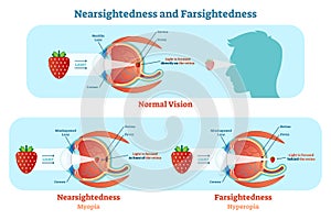Far Sightedness and Near Sightedness vector illustration diagram, anatomical scheme.