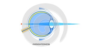 Farsightedness eye disease photo