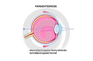 Farsightedness eye disease photo