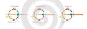 Farsightedness and nearsightedness