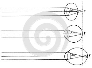 Farsightedness, normal and nearsightedness top to bottom