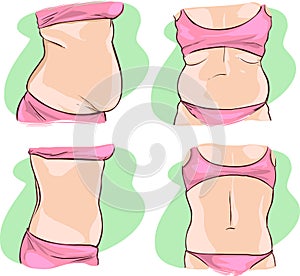 Fat belly before and after treatment.