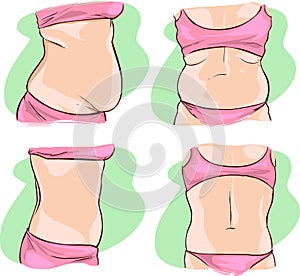 Fat belly before and after treatment. photo