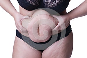 Fat female belly after pregnancy, stretch marks closeup