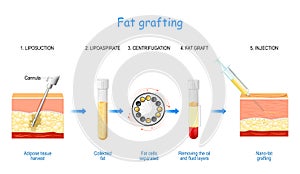 Fat grafting. Nano-fat injection