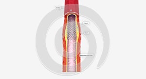 Fat layer accumulating in arteries