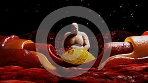 Fat man, blood stream and cholesterol plaque, thrombus. health harm concept. Inside human body.