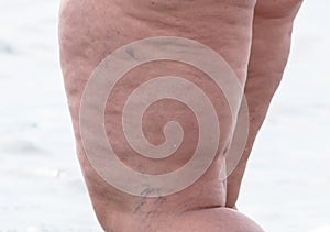 Fat and veins in a woman`s legs