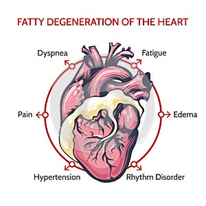 Fatty Degeneration of the Heart. Symptoms of decease illustration photo