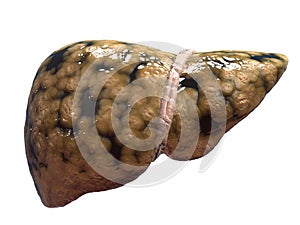 Fatty liver photo