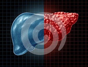 Fatty Liver Disease