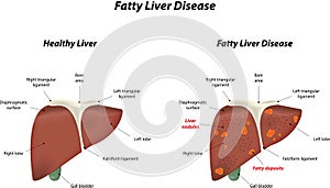 Fatty Liver Disease