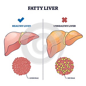 Fatty liver disease with healthy and damaged organ comparison outline diagram