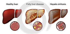 Fatty liver disease. Hepatic cirrhosis