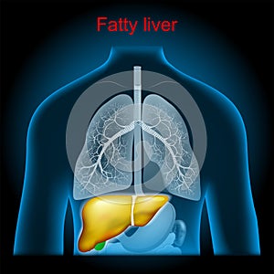 Fatty liver disease. Hepatic steatosi